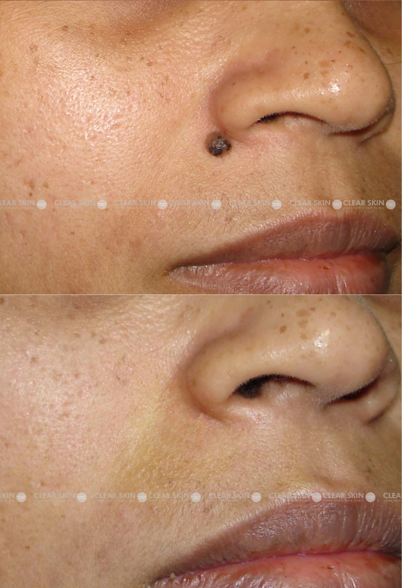 35yrs Female Mole Removal Results 3 Months Timeline 2 Sessions ClearSkin Pune