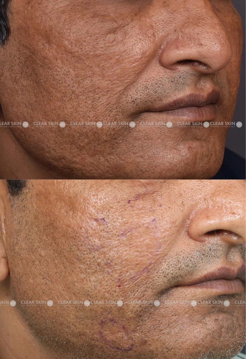 37yrs male Acnescars Results 3 Months Timeline 5 Sessions ClearSkin Pune