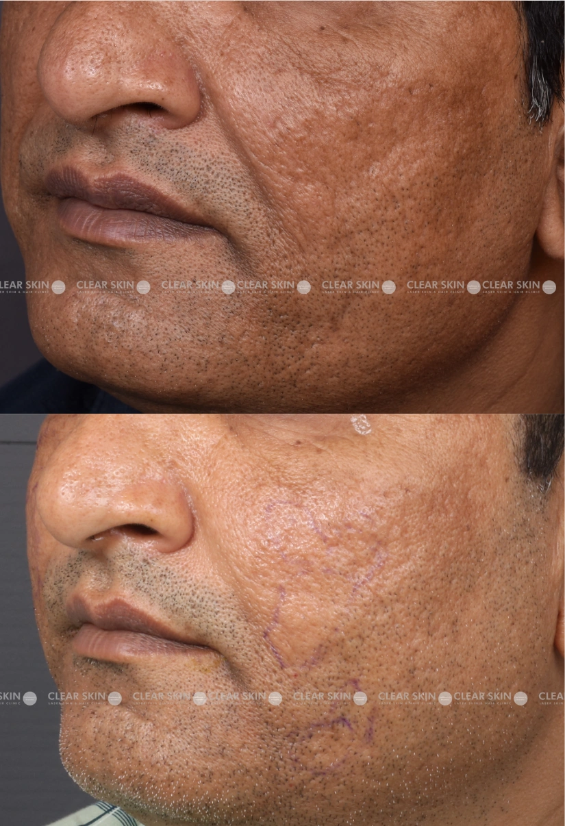 37yrs male Acnescars Results 3 Months Timeline 5 Sessions ClearSkin Pune