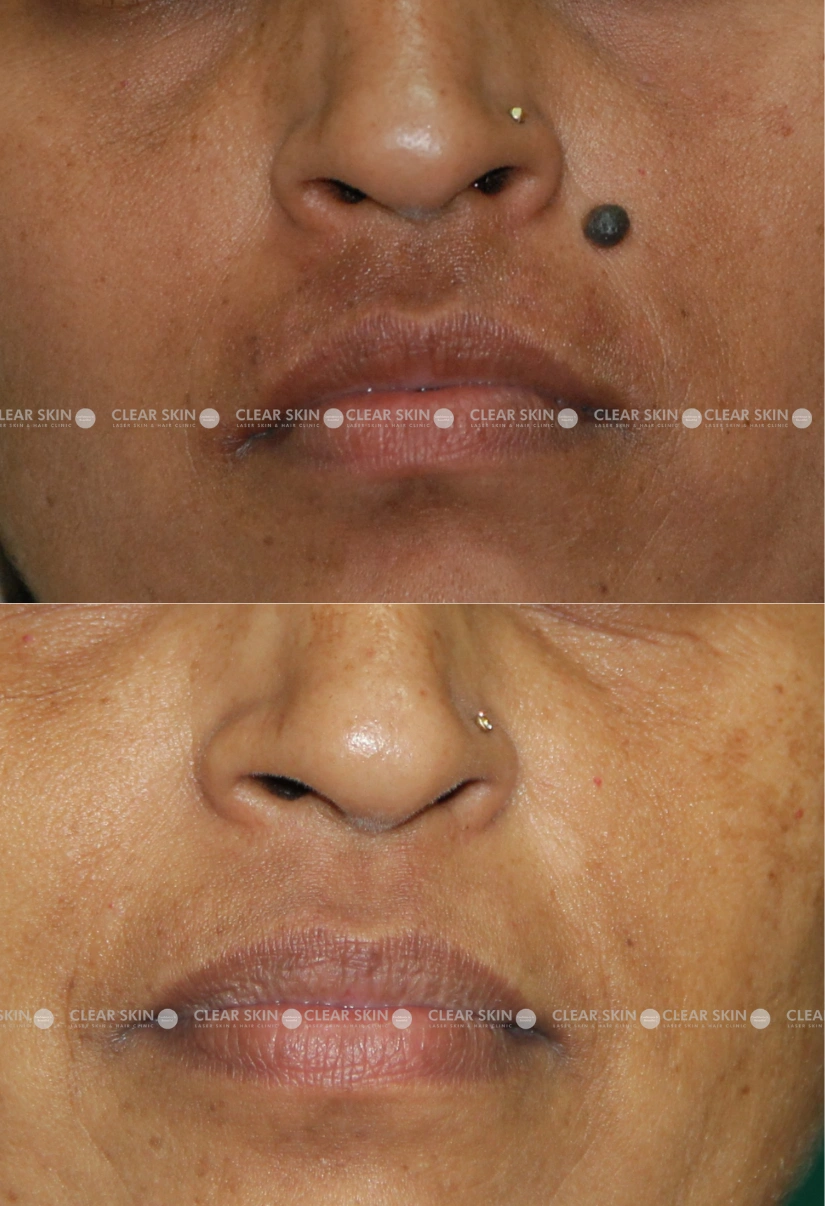 39yrs Female Mole Removal Results 3 Months Timeline 2 Sessions ClearSkin Pune