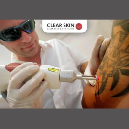 Is Tattoo Removal Painful