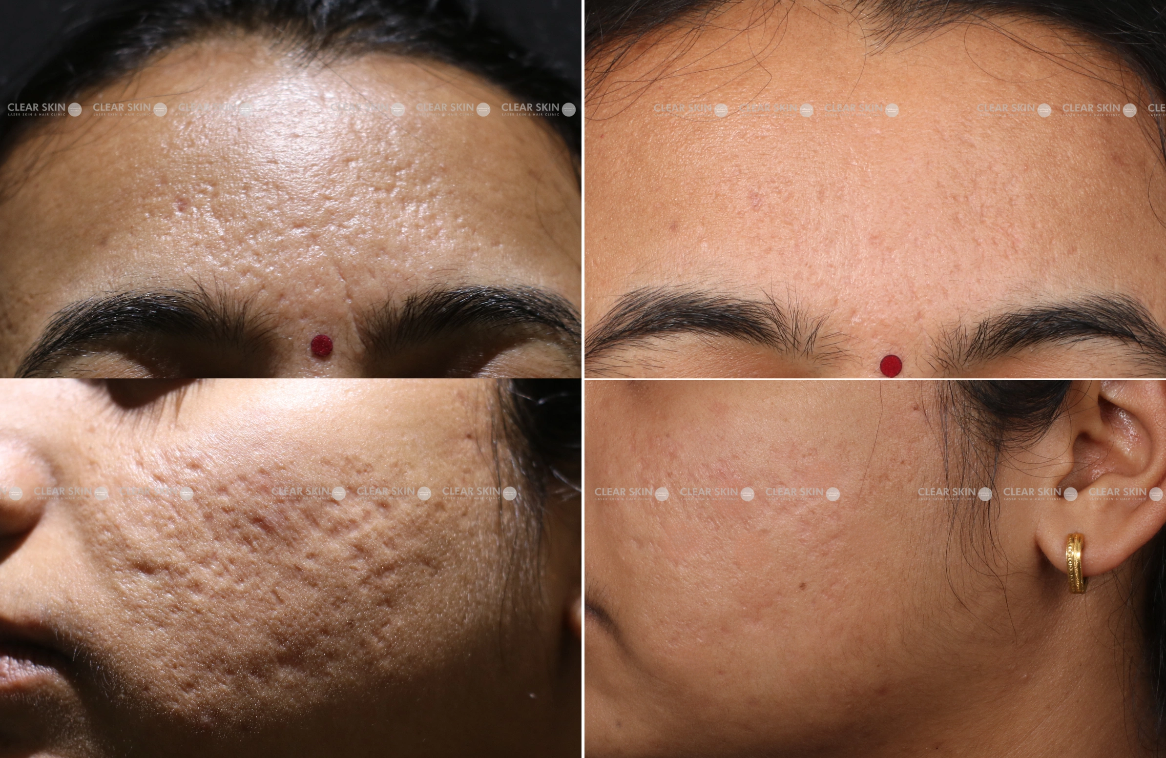 AcneScars Results 6 Months Timeline 7 Sessions ClearSkin Pune