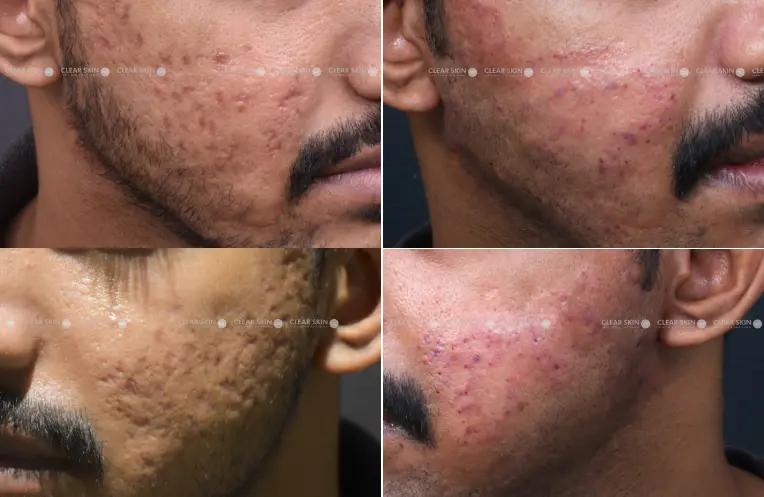 AcneScars Results 6 Months Timeline 7 Sessions ClearSkin Pune