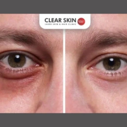 Causes and Treatments of Dark Circles