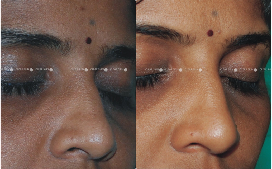 Dark circles Results 5 Sessions 4 Months Clear Skin Pune