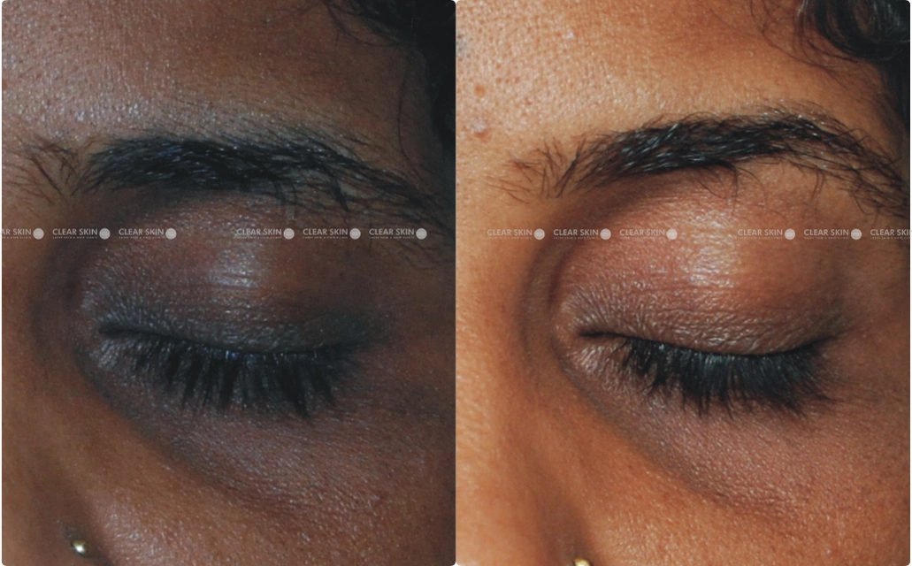 Dark circles Results 5 Sessions 4 Months Clear Skin Pune