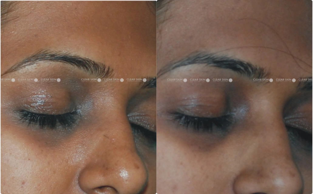 Dark circles Results 5 Sessions 5 Months Clear Skin Pune