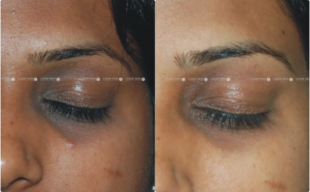 Dark circles Results 5 Sessions 5 Months Clear Skin Pune