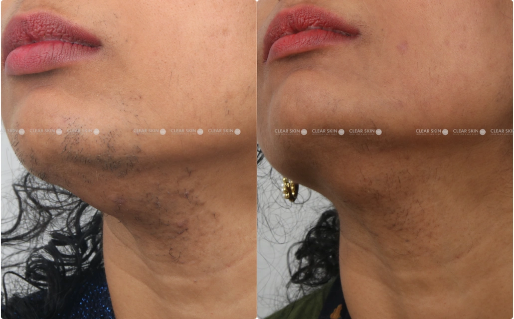 LHR Results 5 Sessions 6  Months Clear Skin Pune