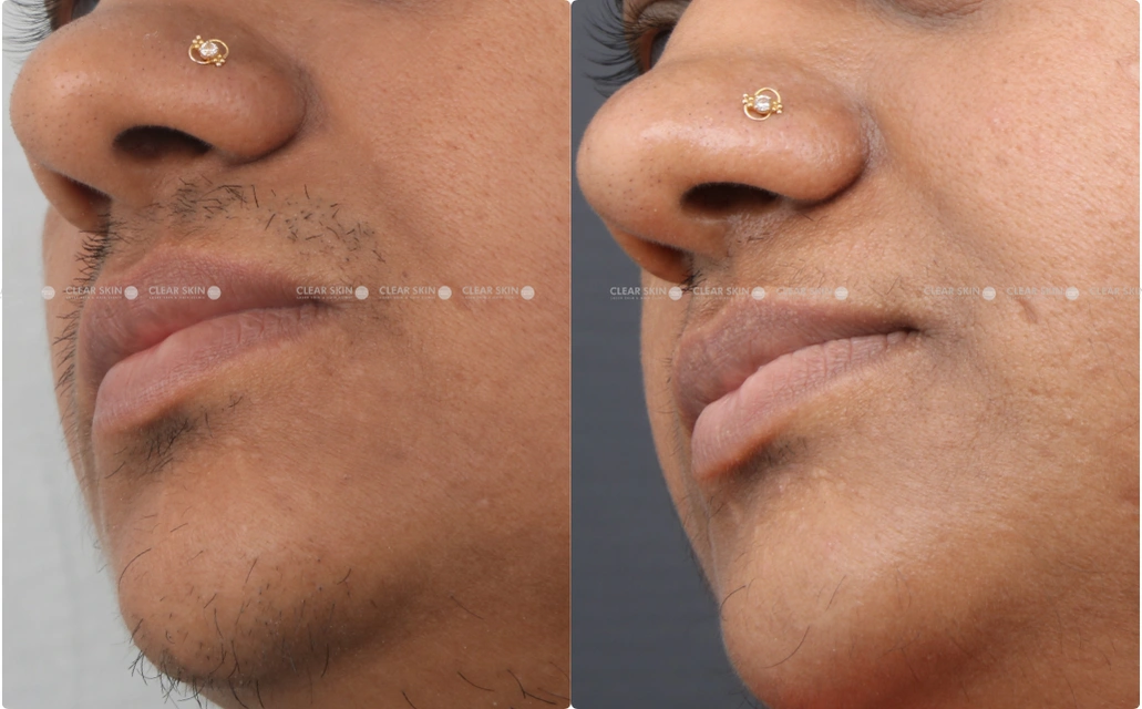 LHR Results 7 Sessions 7 Months Clear Skin Pune