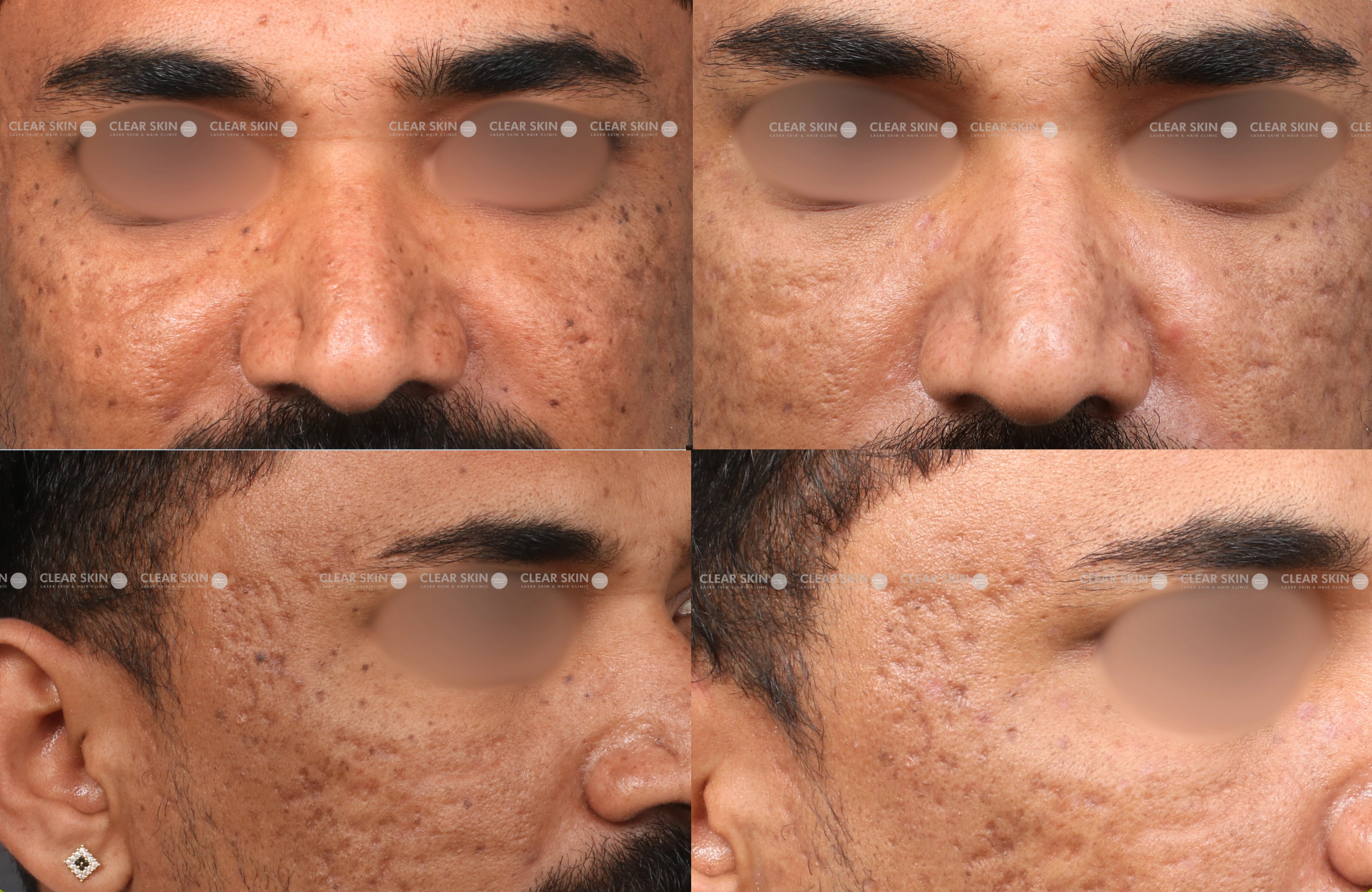 Mole Removal Results 3 Months Timeline 2 Sessions ClearSkin Pune