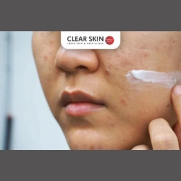 Do Acne Scar Removal Creams Really Work