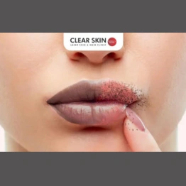 Reduce Lip Pigmentation