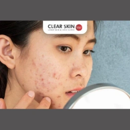 Pregnancy Acne