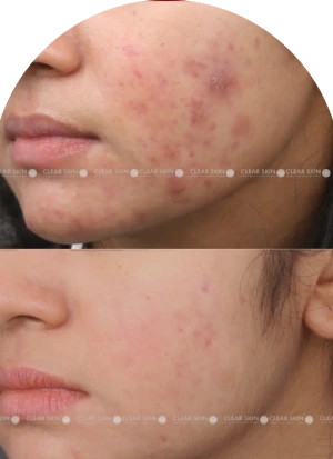 Acne Scars Results 6 Months Timeline Clear Skin Pune