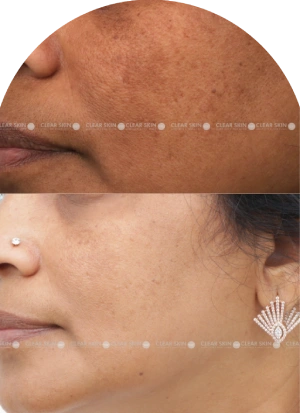 Acne Scars Results 6 Months Timeline Clear Skin Pune