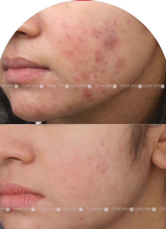 Acne Scars Results 6 Months Timeline Clear Skin Pune