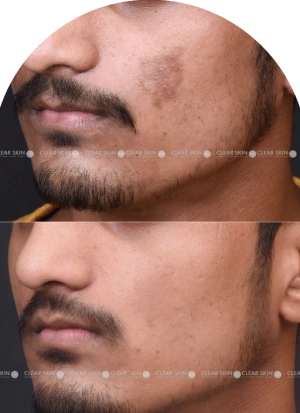 Acne Scars Results 6 Months Timeline Clear Skin Pune