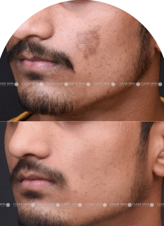 Acne Scars Results 6 Months Timeline Clear Skin Pune