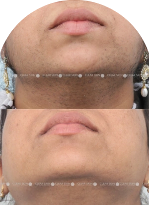 Acne Scars Results 6 Months Timeline Clear Skin Pune