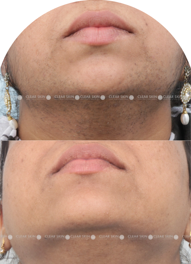 Acne Scars Results 6 Months Timeline Clear Skin Pune