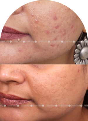 Acne Scars Results 6 Months Timeline Clear Skin Pune