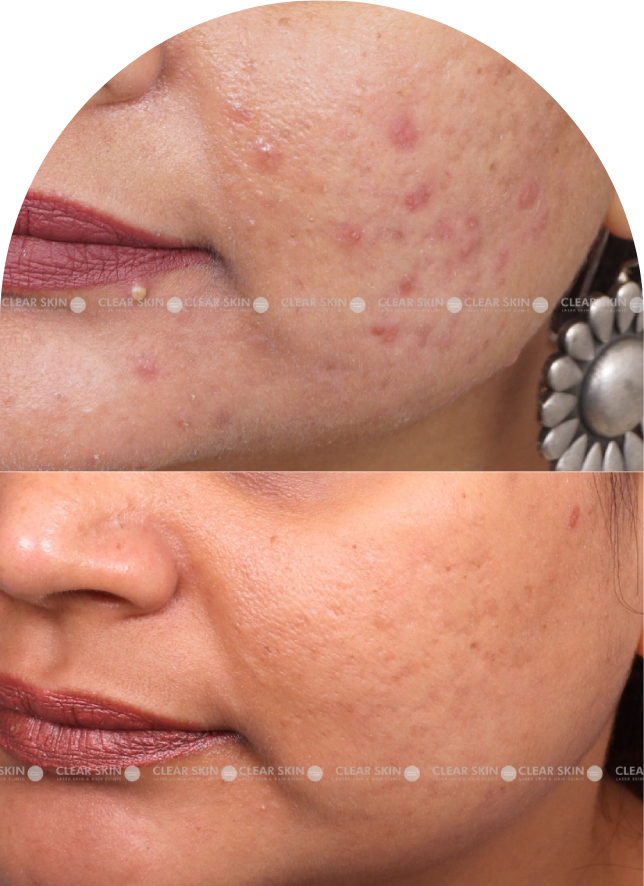 Acne Scars Results 6 Months Timeline Clear Skin Pune