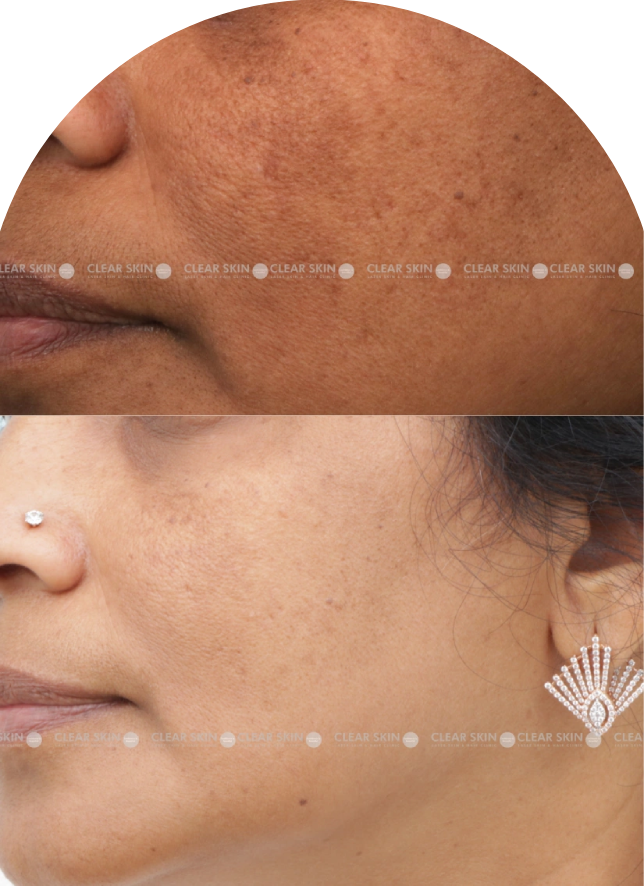 Acne Scars Results 6 Months Timeline Clear Skin Pune