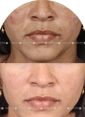 Acne Scars Results 6 Months Timeline Clear Skin Pune