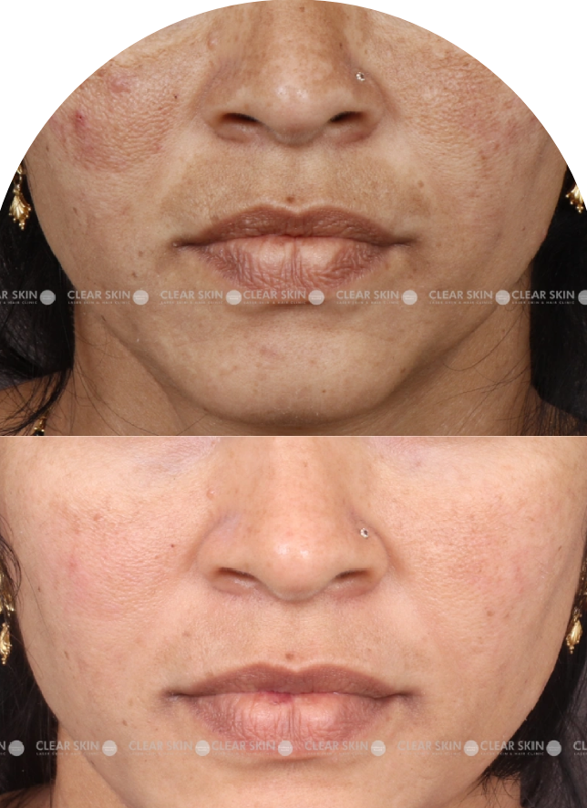 Acne Scars Results 6 Months Timeline Clear Skin Pune