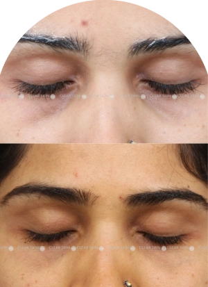 Acne Scars Results 6 Months Timeline Clear Skin Pune