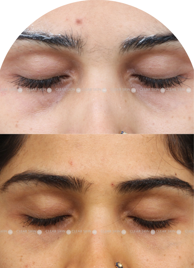 Acne Scars Results 6 Months Timeline Clear Skin Pune