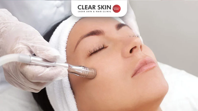 dermabrasion for acne scars