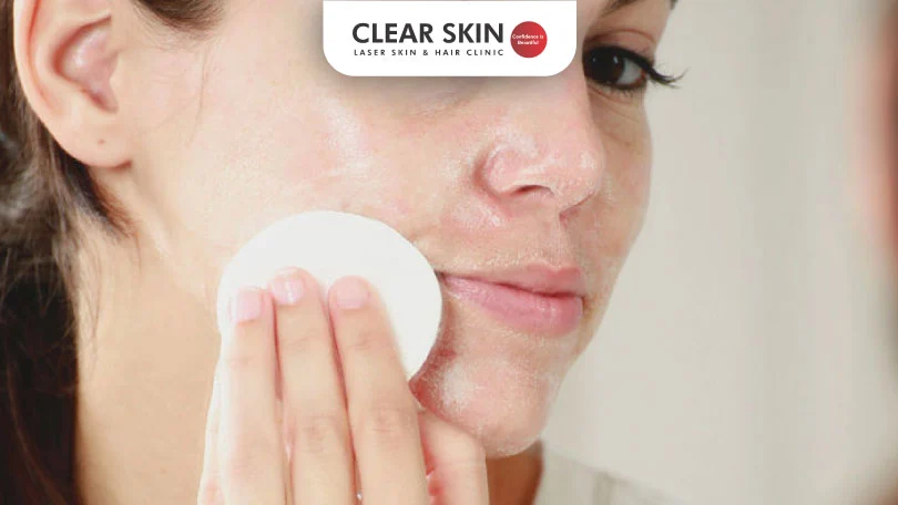 glycolic acid for acne scars