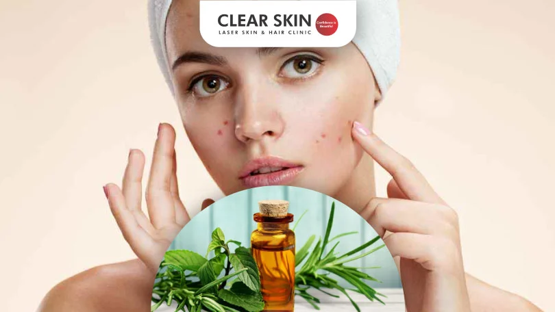 How to Use Tea Tree Oil for Acne