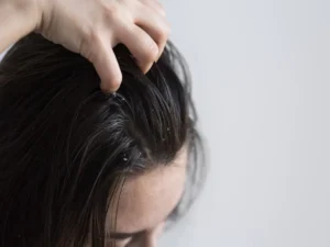 dandruff forehead acne causes