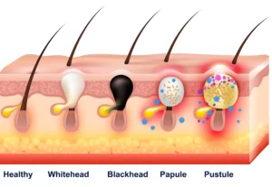 types of acne