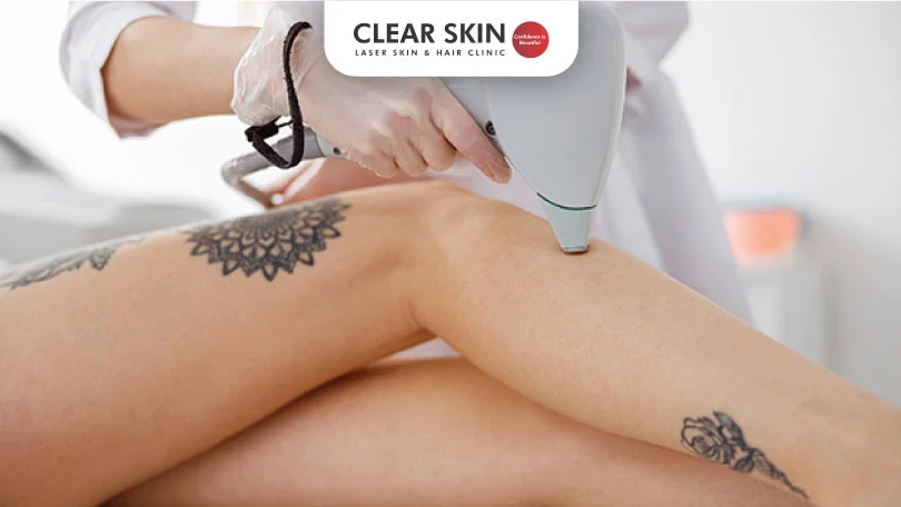 laser hair removal and tattoos