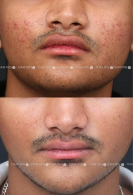 19yrs male Acne Results 6 Months Timeline 5 Sessions ClearSkin Pune