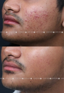 19yrs male Acne Results 6 Months Timeline 5 Sessions ClearSkin Pune (2)