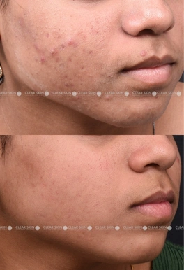 20yrs Female Acne Results 4 Months Timeline 5 Sessions ClearSkin Pune