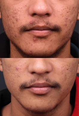 21yrs male Acne Results 6 Months Timeline 6 Sessions ClearSkin Pune