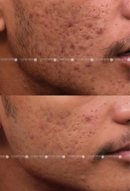 21yrs male Acne Results 6 Months Timeline 6 Sessions ClearSkin Pune