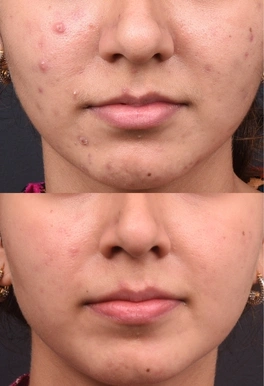 24yrs Female Acne Results 4 Months Timeline 5 Sessions ClearSkin Pune