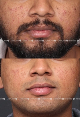 27yrs male Acne Results 6 Months Timeline 7 Sessions ClearSkin Pune