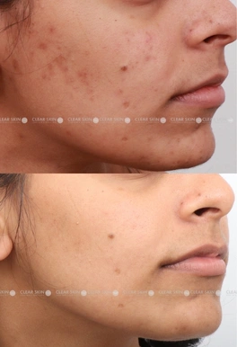 25yrs Female Acne Results 3 Months Timeline 3 Sessions ClearSkin Pune