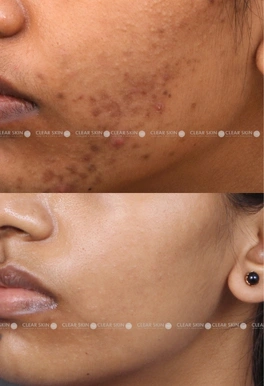 25yrs Female Acne Results 6 Months Timeline 5 Sessions ClearSkin Pune (2)