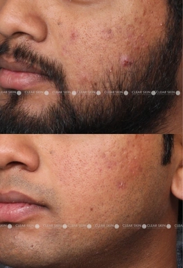 27yrs male Acne Results 6 Months Timeline 7 Sessions ClearSkin Pune