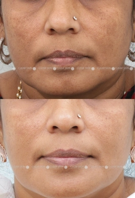 43years Female Anti-Aging Results 4 Months Timeline 5 Sessions ClearSkin Pune