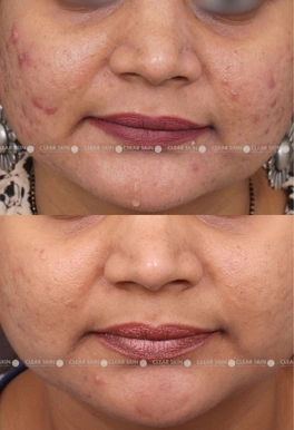 40yrs Female Acne Results 6 Months Timeline 7 Sessions ClearSkin Pune